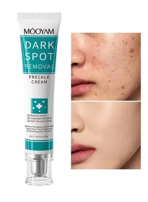 MOOYAM Dark Spot Removal Freckle Cream 🌿